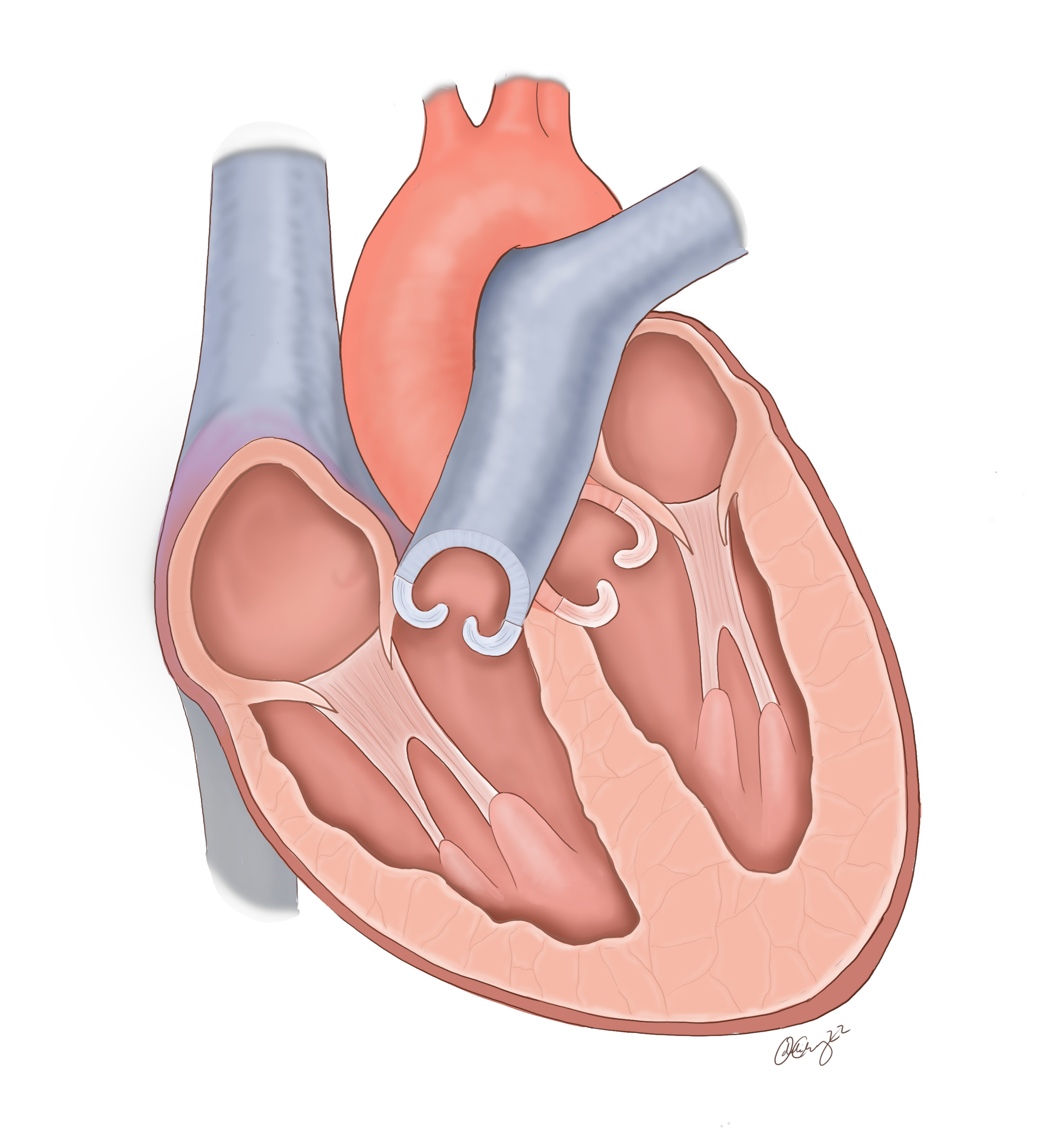 Arterial Switch