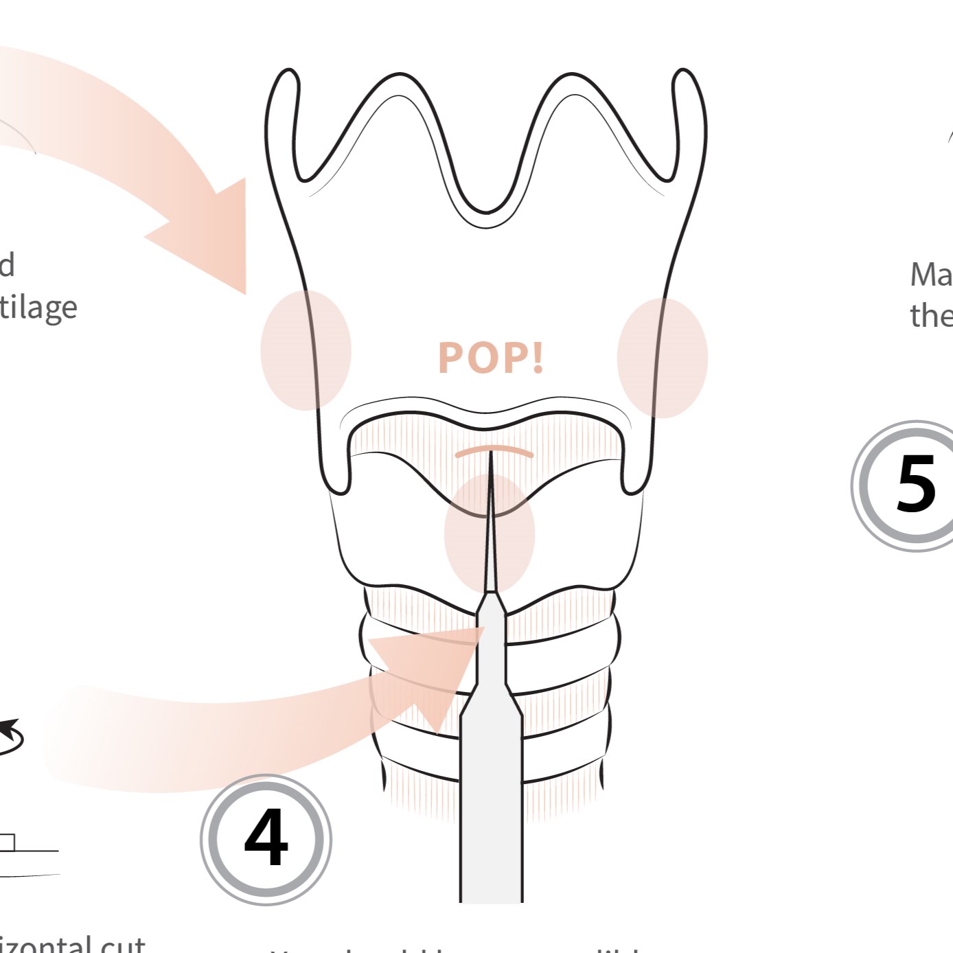 Cricothyrotomy